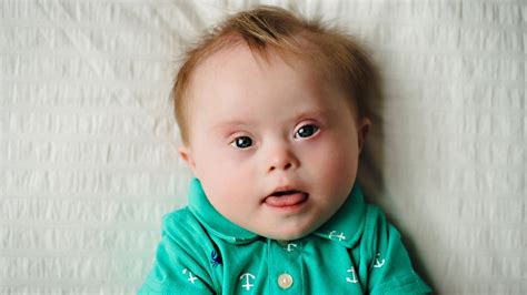 People with mosaic Down syndrome can manifest all, some or none of the symptoms of the more common form of Down syndrome, including short stature, slanted eyes, intellectual disability and heart defects.